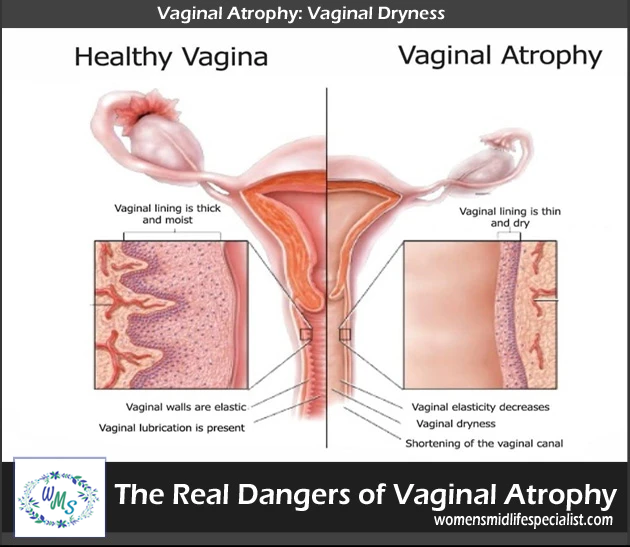 Real Dangers of Vaginal Atrophy