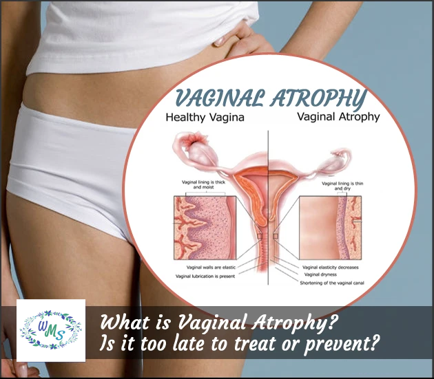 Do you know the Real Dangers of Vaginal Atrophy?